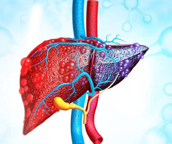 Liver transplant still unaffordable despite spiking cases